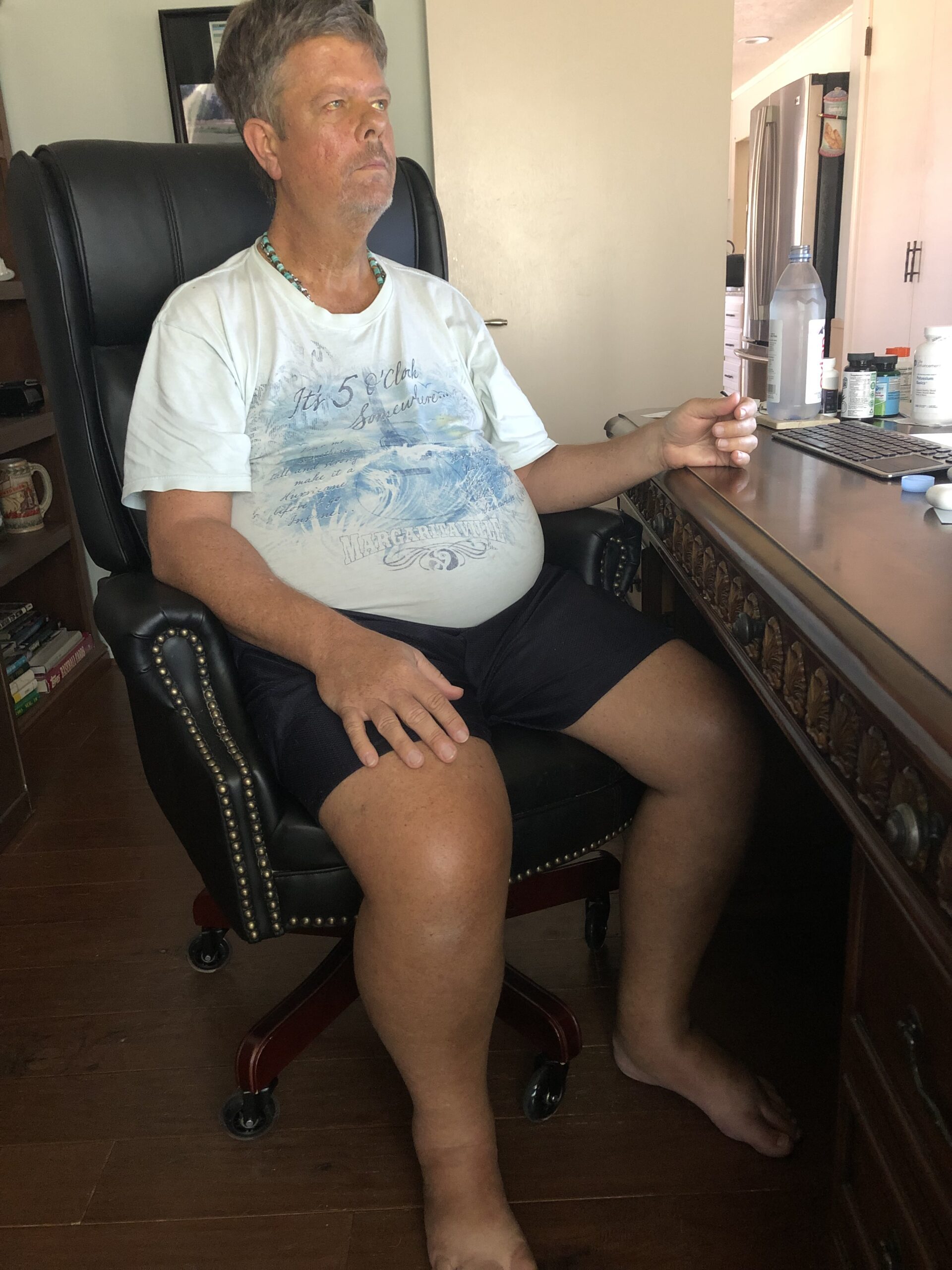 Scott during one of his lowest points with severe ascites and jaundice, after gaining over 25 pounds of fluid in a single week — a powerful visual reminder of just how far he’s come.