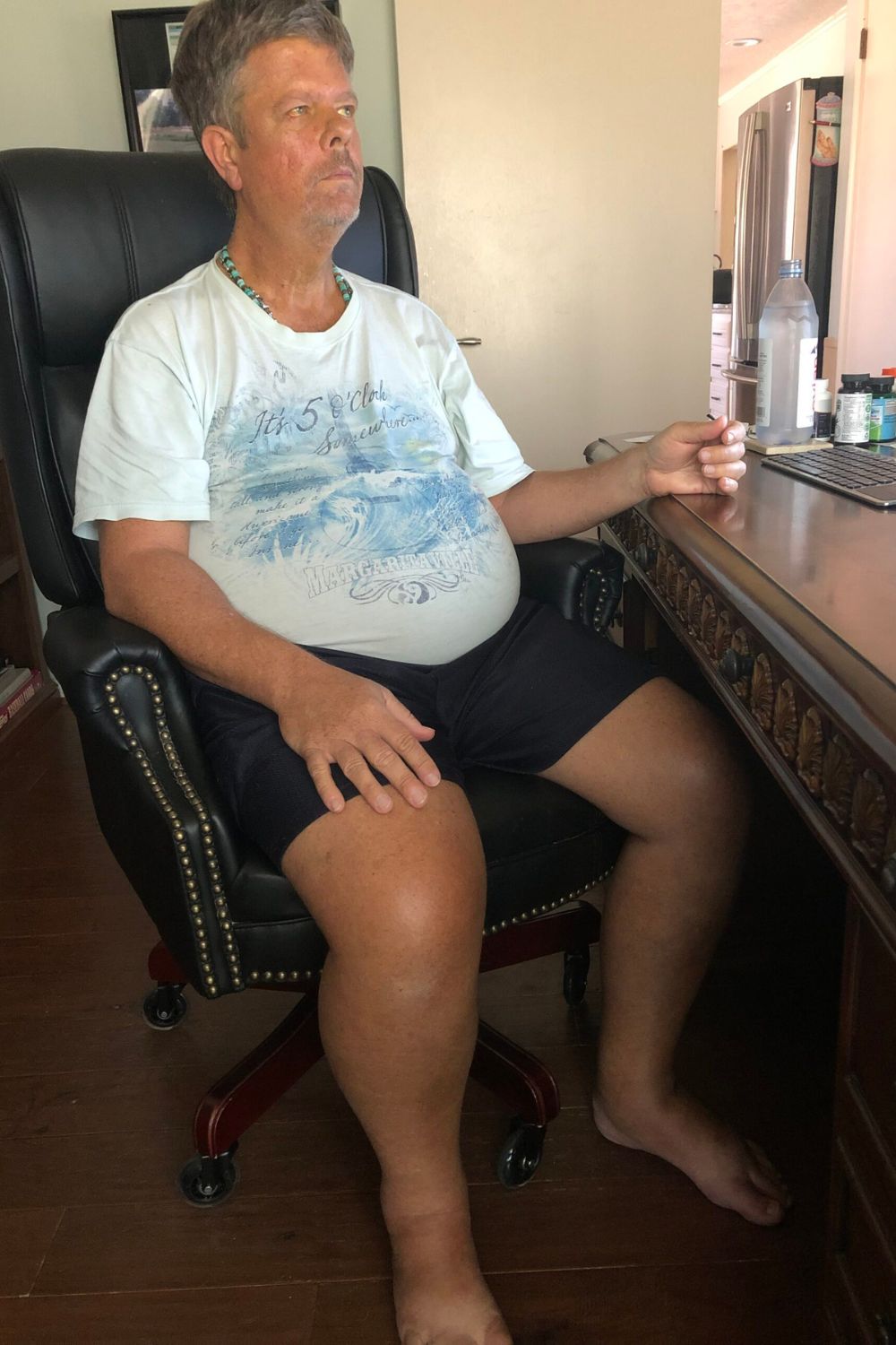 Scott during one of his lowest points with severe ascites and jaundice, after gaining over 25 pounds of fluid in a single week — a powerful visual reminder of just how far he’s come.