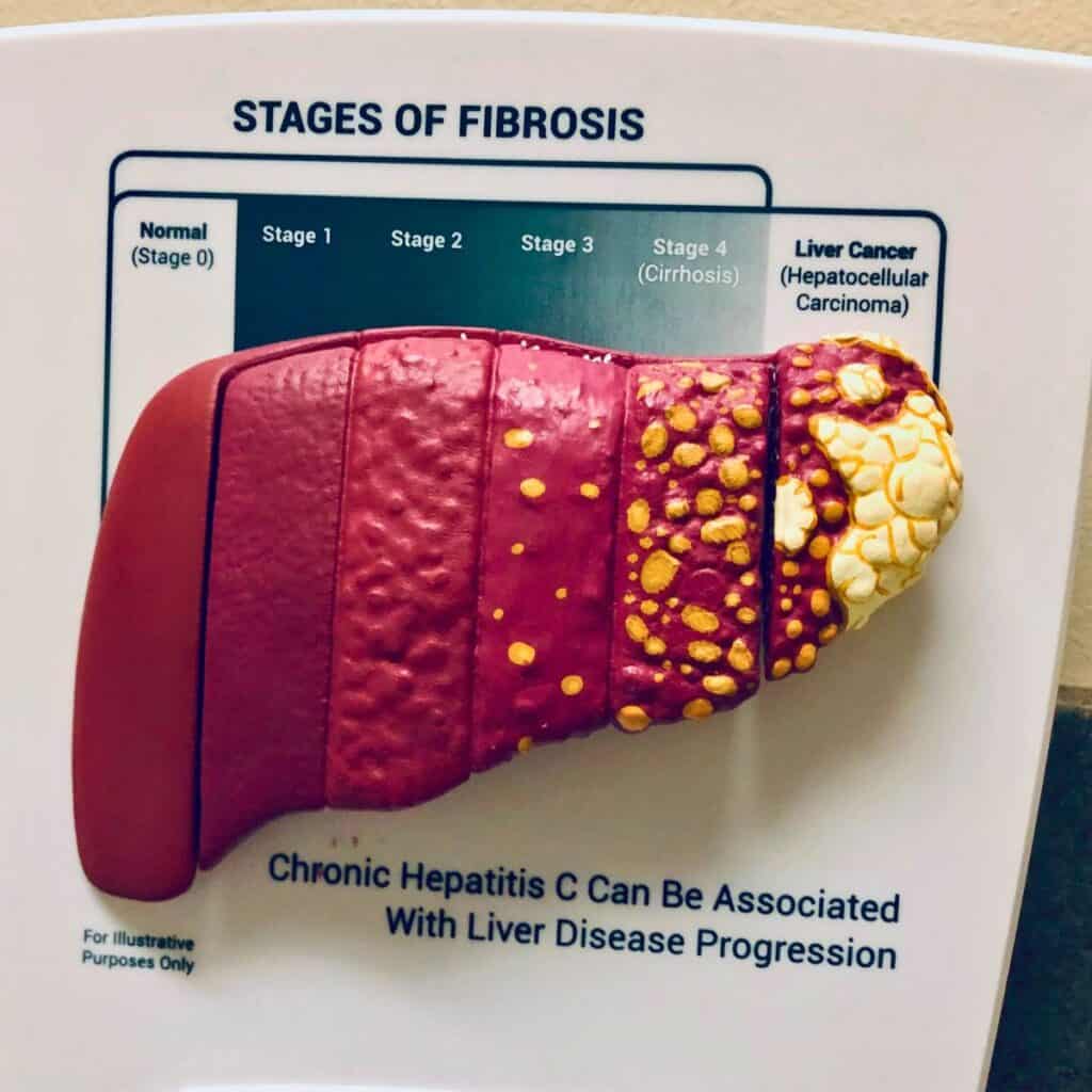 Scott’s bloodwork timeline context showing stages of liver fibrosis and progression of liver disease.